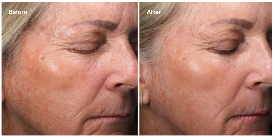 A side-by-side "Before and After" comparison of an older person's face. The "Before" image shows visible fine lines, wrinkles, and sun spots, while the "After" image displays smoother skin with reduced lines and a more even tone.