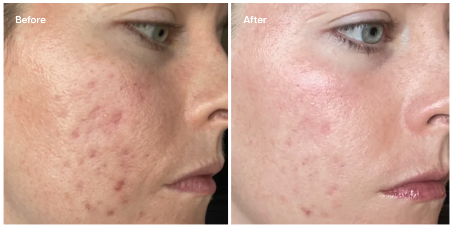 A side-by-side "Before and After" comparison of a person's face. The "Before" image shows visible acne, redness, and some scarring, while the "After" image displays significantly clearer skin with reduced blemishes, less redness, and a smoother appearance.
