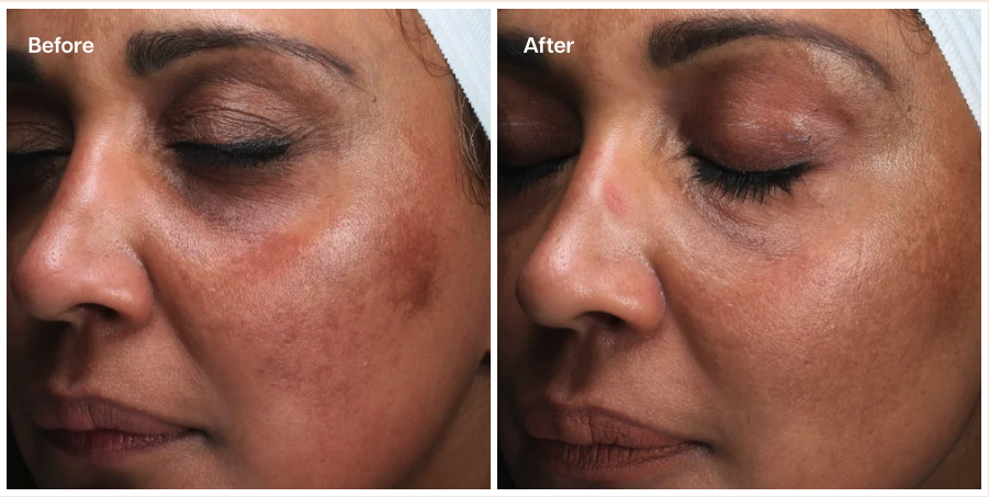 A side-by-side "Before and After" comparison of a person's face. The "Before" image shows visible hyperpigmentation and uneven skin tone, while the "After" image displays a significantly brighter and more even complexion with reduced dark spots.