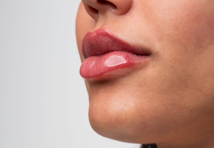Close-up of plump, glossy lips after lip filler treatment at Skin Laundry UAE