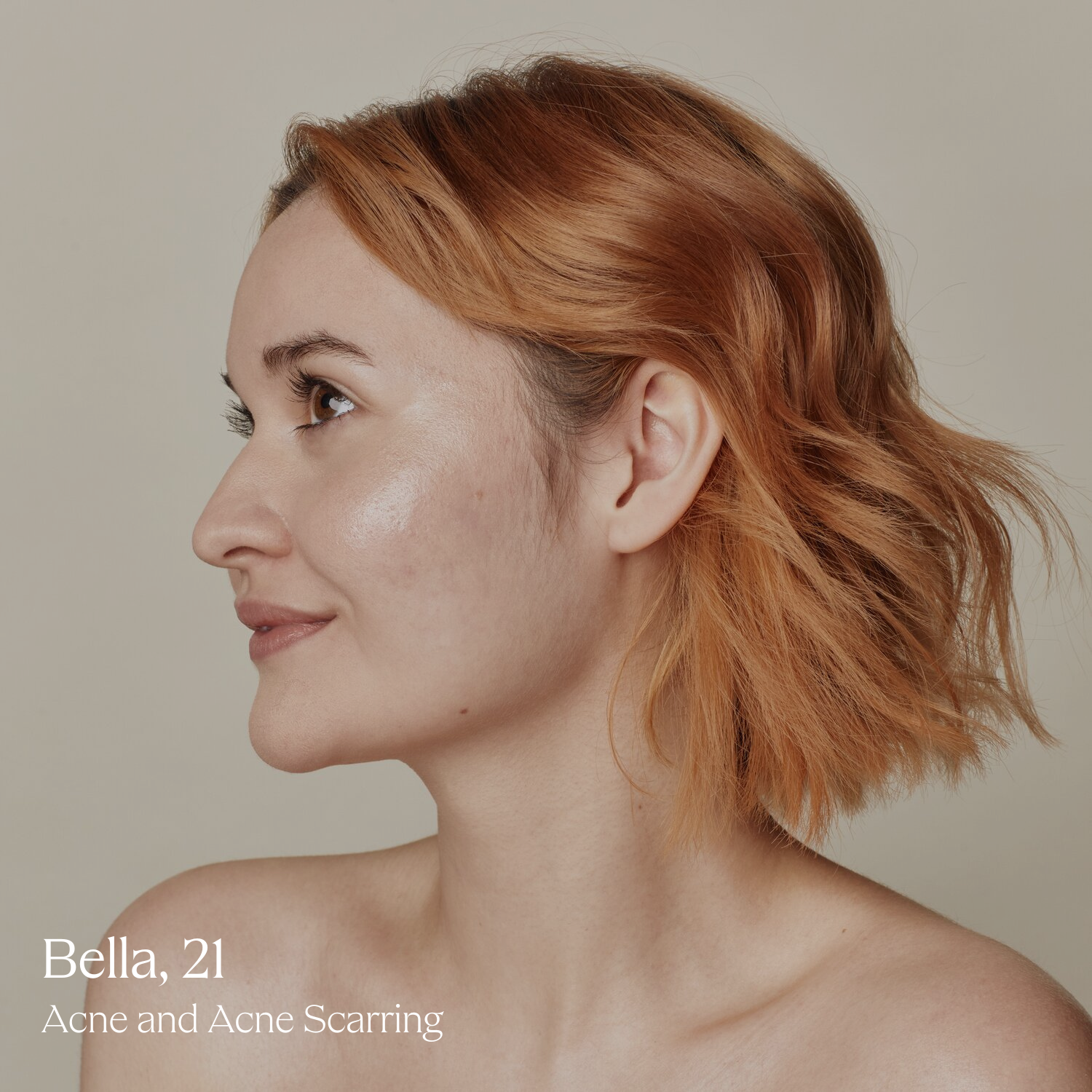 Bella, 21, with clearer skin after laser facials for acne and acne scarring at Skin Laundry UAE