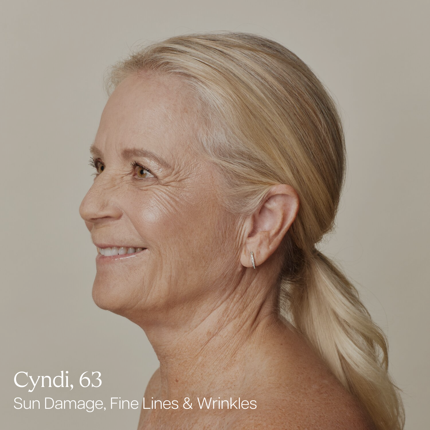 Cyndi, 63, after laser facial treatments for sun damage, fine lines, and wrinkles at Skin Laundry UAE