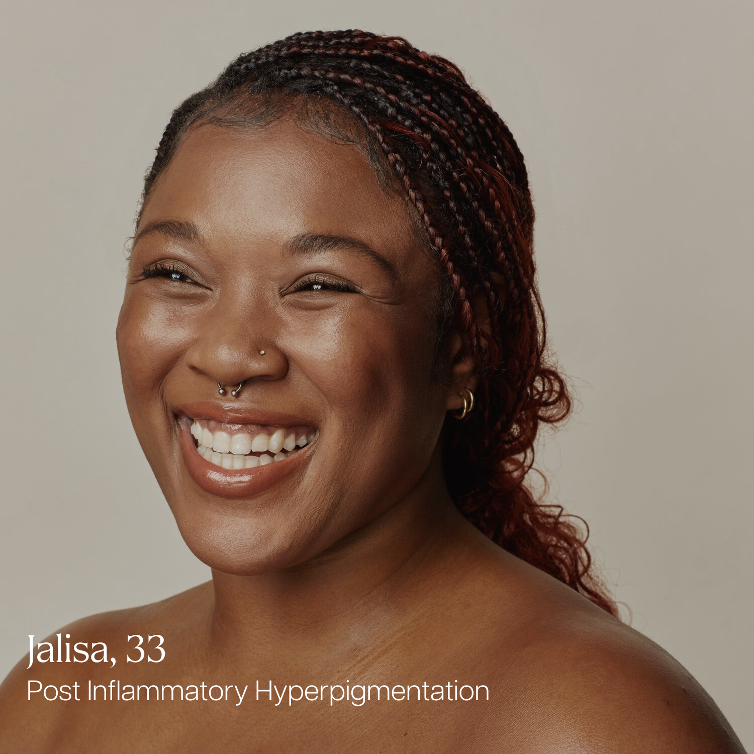Jalisa, 33, smiling after treating post-inflammatory hyperpigmentation with laser facials at Skin Laundry UAE