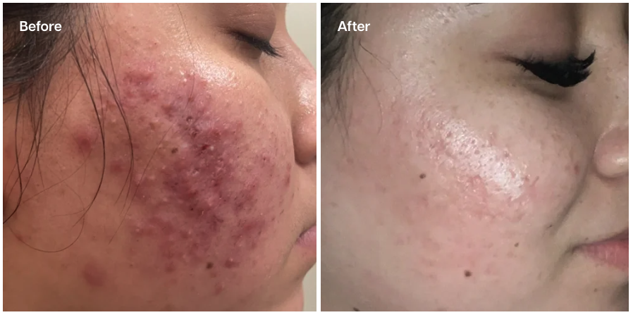 Before and after results of acne treatment with laser facial at Skin Laundry UAE