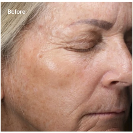 A close-up "Before" image of an older person's face, showing visible fine lines around the eyes, age spots, and an uneven skin tone on the cheek and forehead.