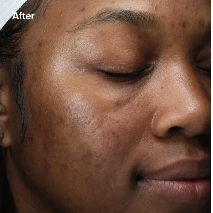 A close-up "After" image of a person's face with dark skin, showing a significantly more even skin tone and reduced appearance of hyperpigmentation and blemishes.