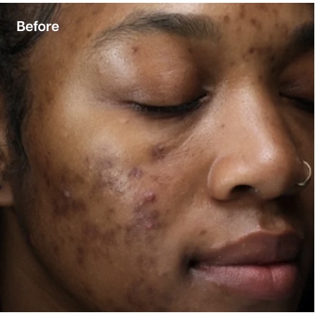 A close-up "Before" image of a person's face with dark skin, showing visible acne, redness, and post-inflammatory hyperpigmentation on the cheek and jawline.